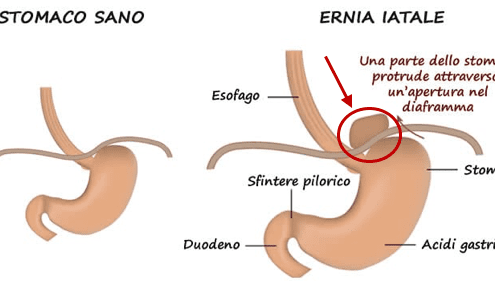 Ernia iatale: Definizione, cause e rimedi osteopatici